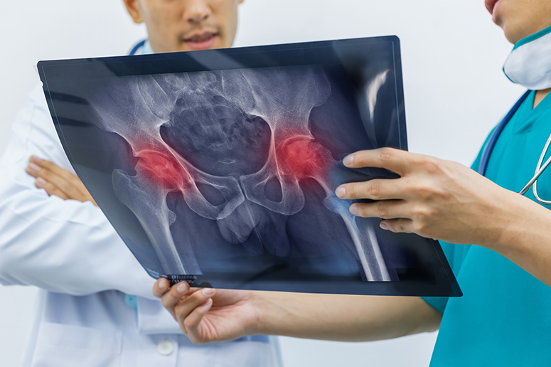 hip replacement image